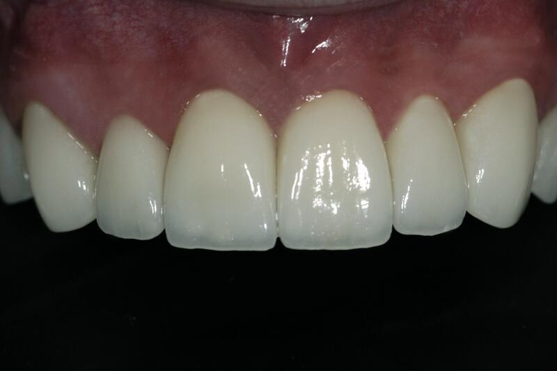 Veneers Before & After photo