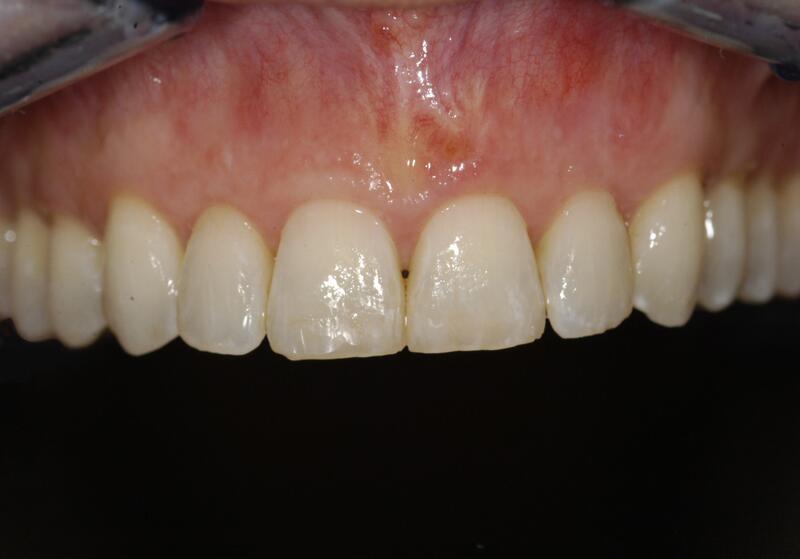 Veneers Before & After photo