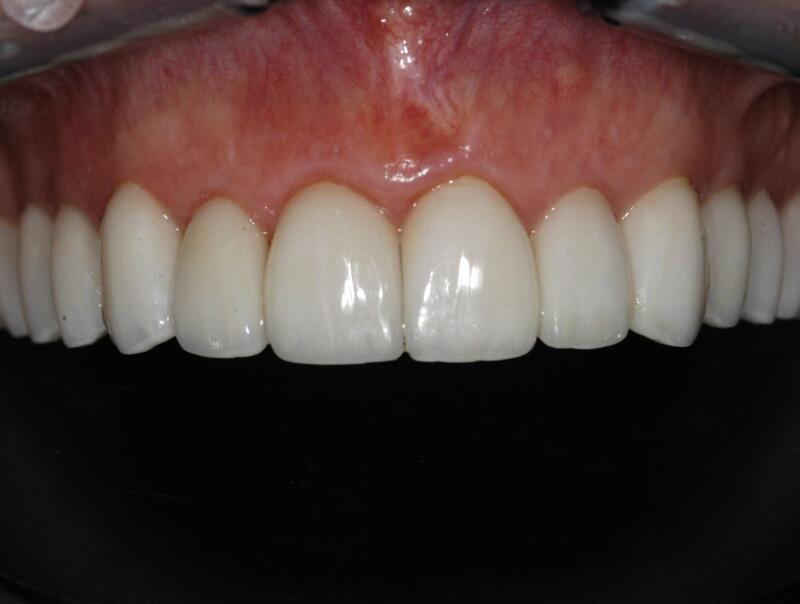 Veneers Before & After photo