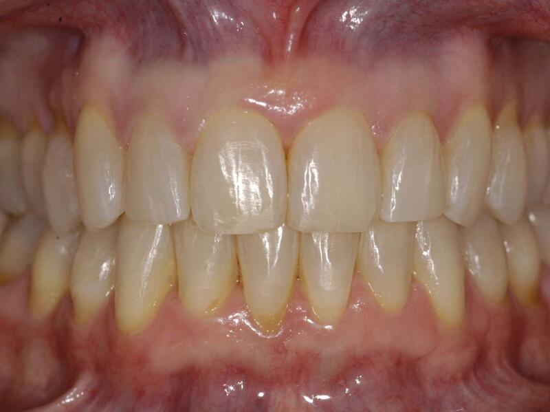 Veneers Before & After photo