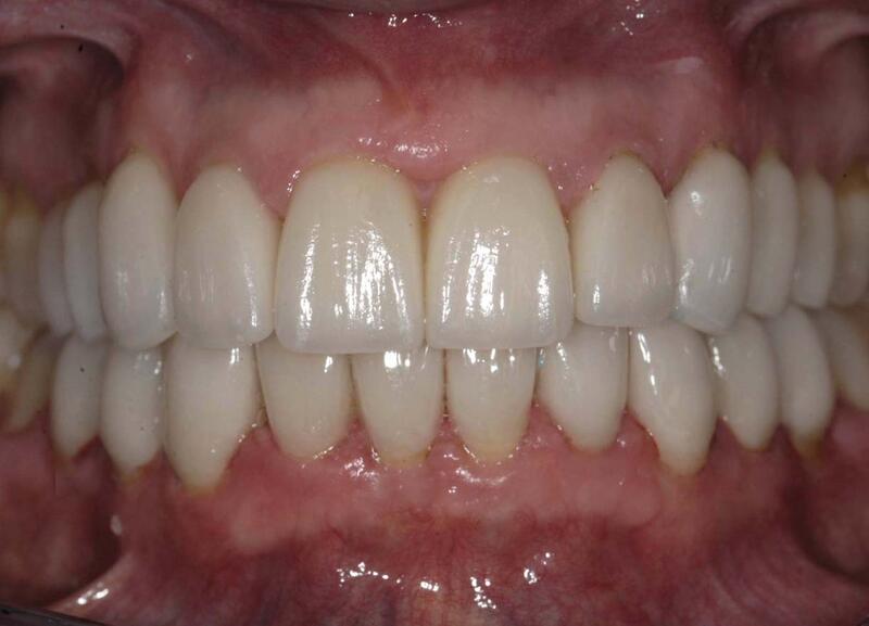 Veneers Before & After photo