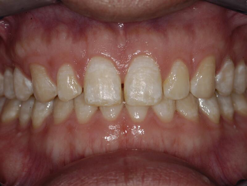 Veneers Before & After photo