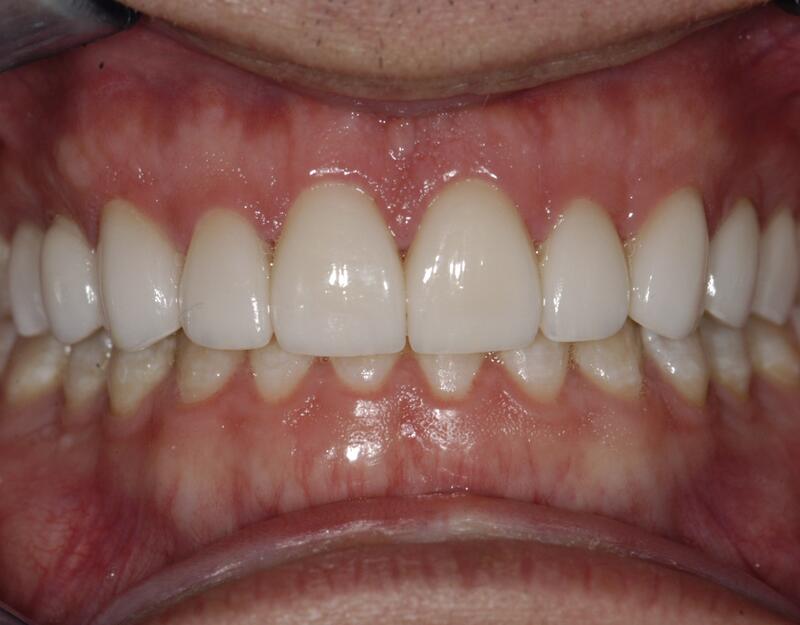 Veneers Before & After photo