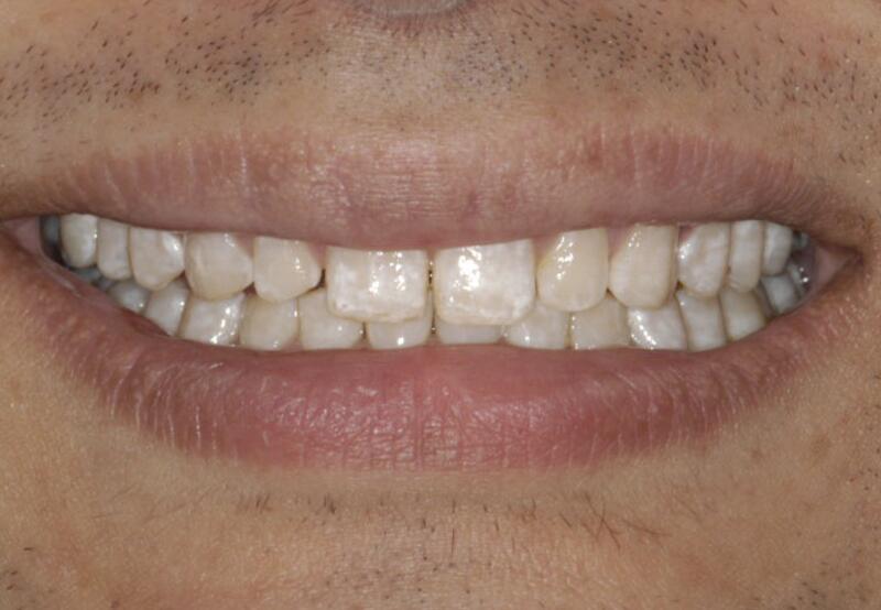 Veneers Before & After photo