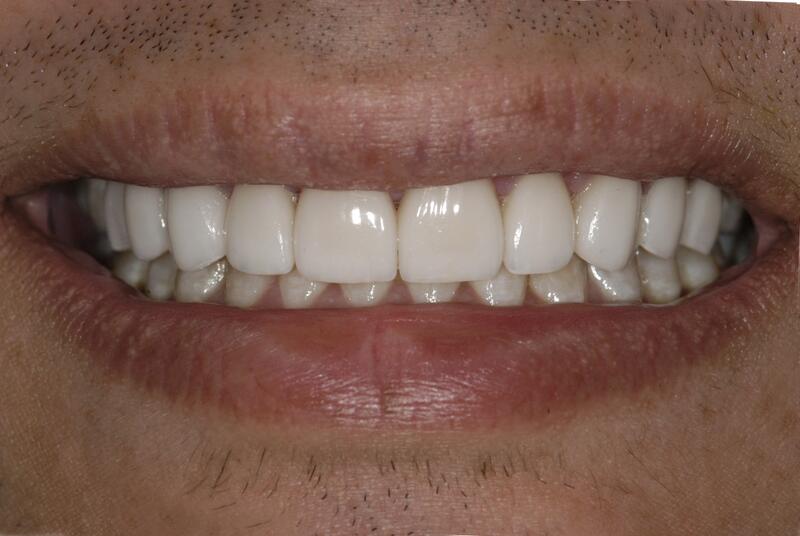 Veneers Before & After photo