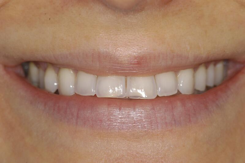 Veneers Before & After photo