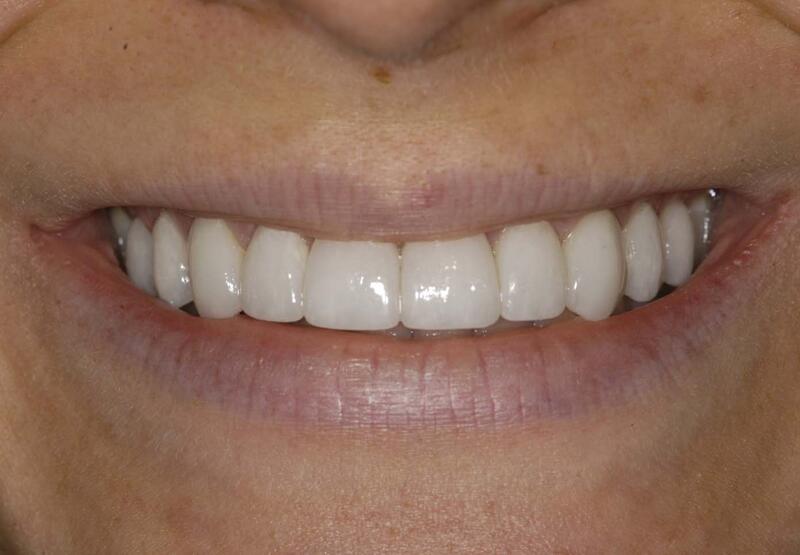 Veneers Before & After photo