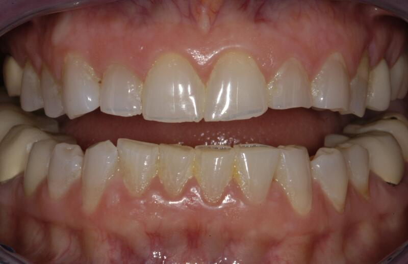 Veneers Before & After photo