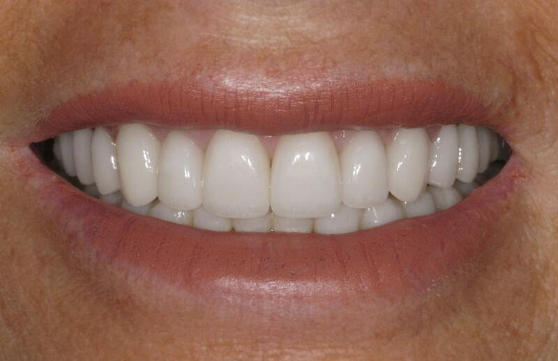 Veneers Before & After photo