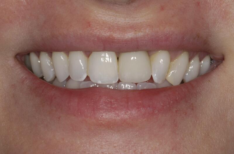 Veneers Before & After photo