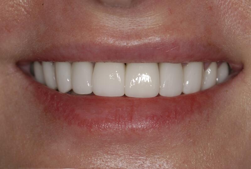 Veneers Before & After photo