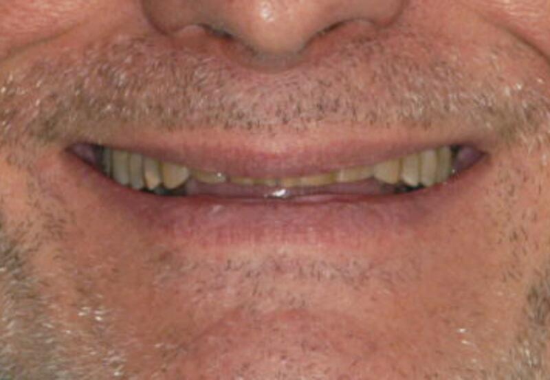 Veneers Before & After photo