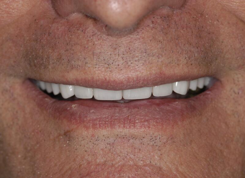 Veneers Before & After photo