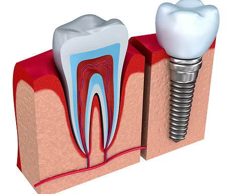 Implants Dentist in Spring