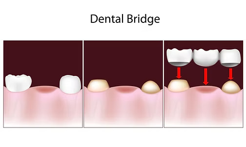 Dental Bridges in Spring