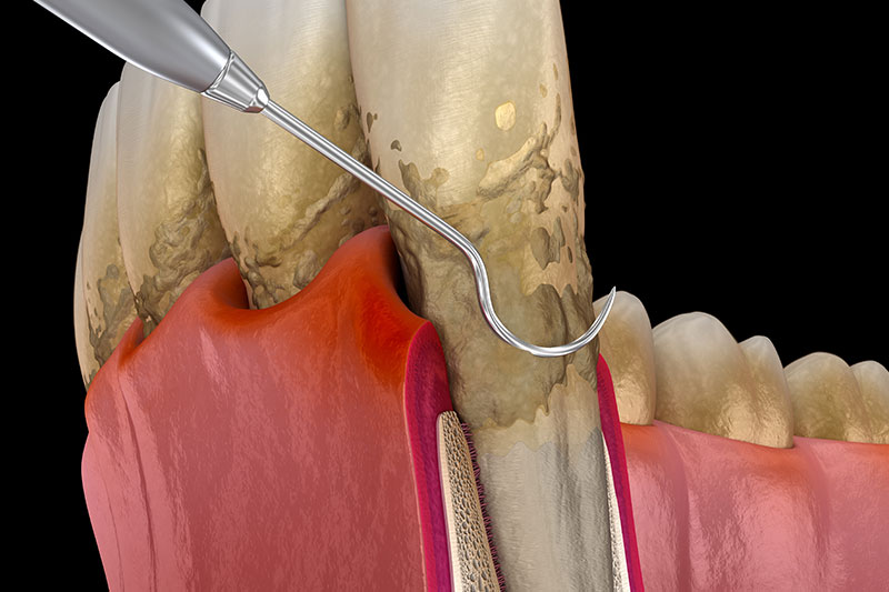 Periodontal Treatment in Spring