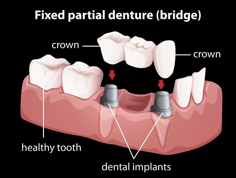 Implant Supported Bridges (Fixed) in Spring