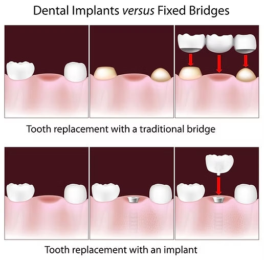 Single Tooth Replacement in Spring