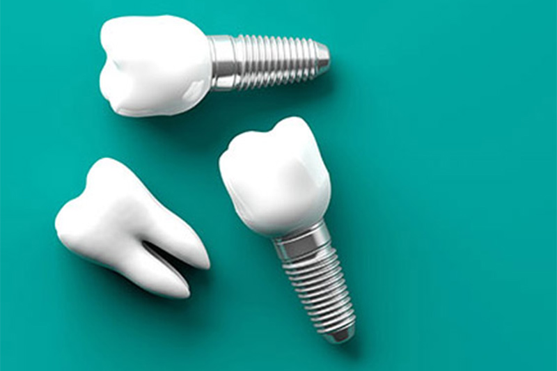 Dental Implants in Meridian