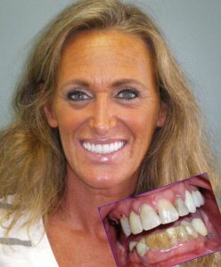 All on 4 Teeth in a Day in Morton Grove