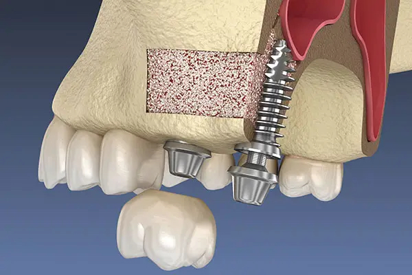 Bone Grafting in Morton Grove