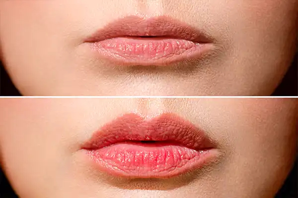 Lip Lift in Morton Grove