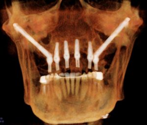 Zygomatic Dental Implants in 