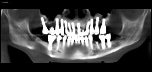 Zygomatic Dental Implants in 