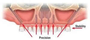 Zygomatic Dental Implants in Morton Grove