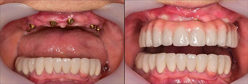 Implant Overdentures and Fixed All-On-X Treatment  - Integra Dental, Chicago Dentist