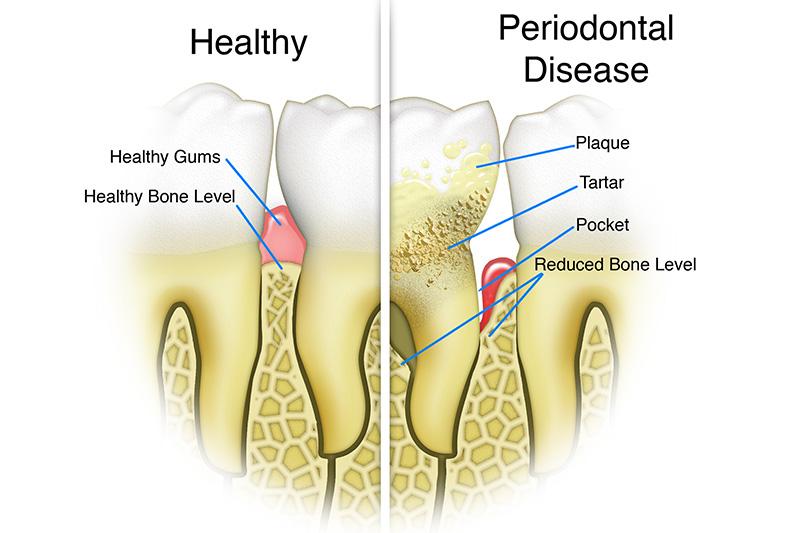 Scaling & Root Planings (Deep Cleanings)  - Integra Dental, Chicago Dentist