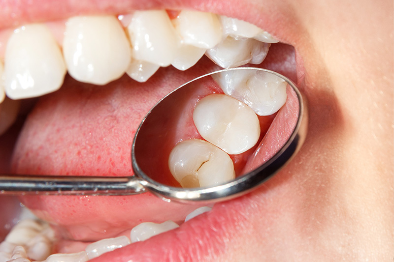 Tooth Colored Composite Fillings  - Integra Dental, Chicago Dentist